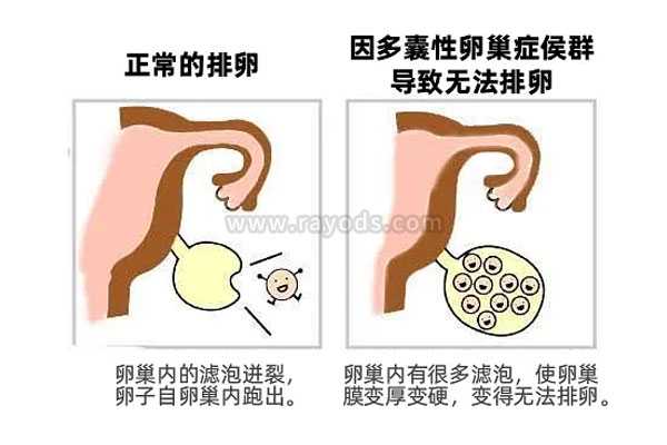 广州代生选男女，多囊做试管婴儿成功率高吗 如何提高试管婴儿成功率